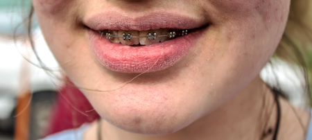 Braces mouth girlsの写真素材