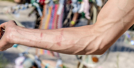 Swollen veins and scars on the arm