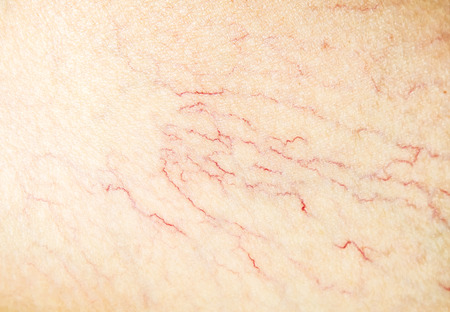 Varicose on the leg close-upの写真素材
