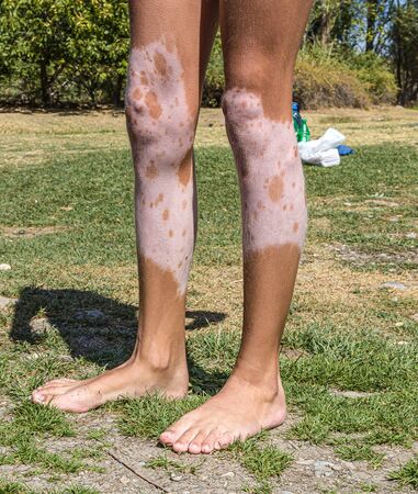 Legs of a girl with vitiligoの写真素材