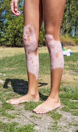 Legs of a girl with vitiligoの写真素材