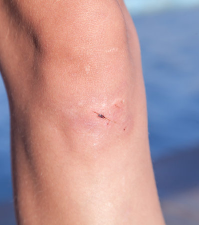 Abrasions on the knees of a young girl close-up. Injured knee of a child after playing on the playgroundの写真素材