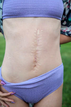 Close-up of a young woman with a large scar after an operation on her stomach. The concept of treatment and removal of scars.の写真素材