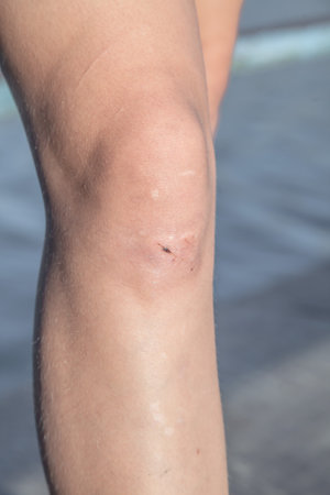 Abrasions on the knees of a young girl close-up. Injured knee of a child after playing on the playgroundの写真素材