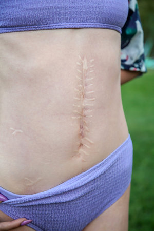 Close-up of a young woman with a large scar after an operation on her stomach. The concept of treatment and removal of scars.の写真素材