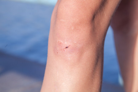 Abrasions on the knees of a young girl close-up. Injured knee of a child after playing on the playgroundの写真素材