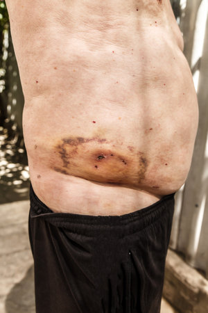 A man was bitten on the side by a dog close-up of the woundの写真素材