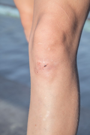 Abrasions on the knees of a young girl close-up. Injured knee of a child after playing on the playgroundの写真素材