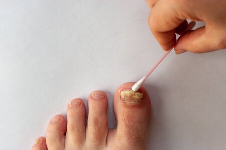 Toenail care with fungus. Toenail plate is affected by fungus. Female hand with a cotton swab. Copy space.の写真素材
