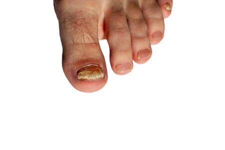 Fungus on toenails. Toenail plate is affected by fungus. Nail plates of toes are disfigured. Isolated.の写真素材