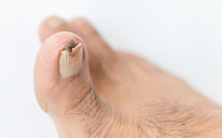 Broken toenail on white backgroundの写真素材