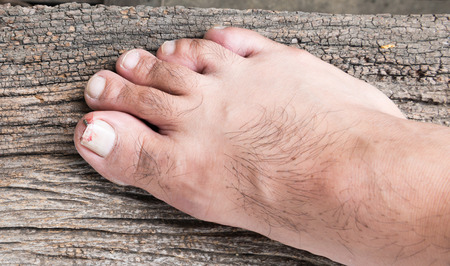 Broken toenail on wood backgroundの写真素材