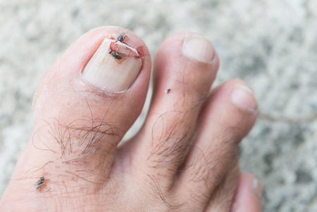 Broken toenailの写真素材