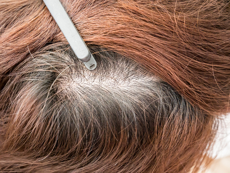 woman head with thinning hair, hair lossの写真素材