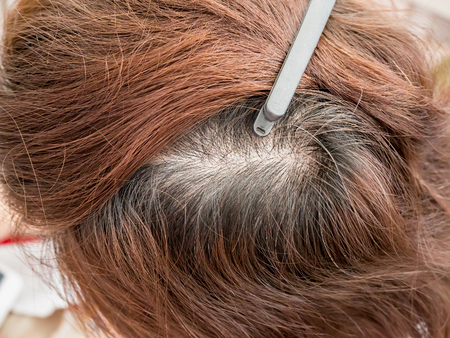 woman head with thinning hair, hair lossの写真素材