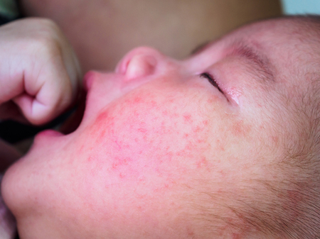 newborn baby with dermatitis allergy on face