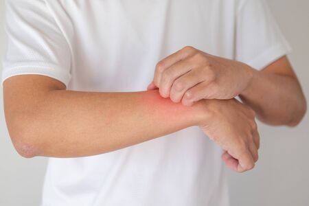 man itching and scratching on arm from itchy dry skin eczema dermatitis