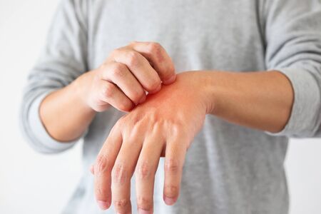 Young asian man itching and scratching on hand from itchy dry skin eczema dermatitisの写真素材