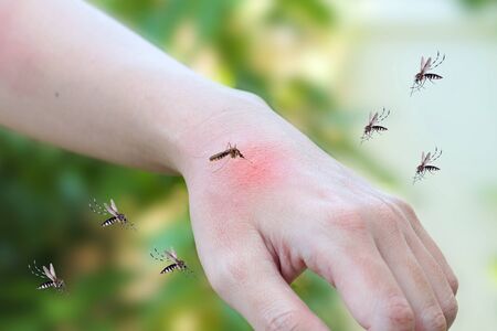 Mosquitoes bite on adult hand made skin rash and allergy with red spotの写真素材