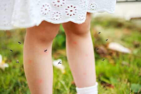 cute asian little girl has skin rash and allergy from mosquito bite and sucking blood at legs while playing on green grass field outdoorの写真素材