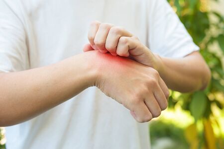 Man itching and scratching on hand from allergy skin rash cause by insect bite outdoorの写真素材