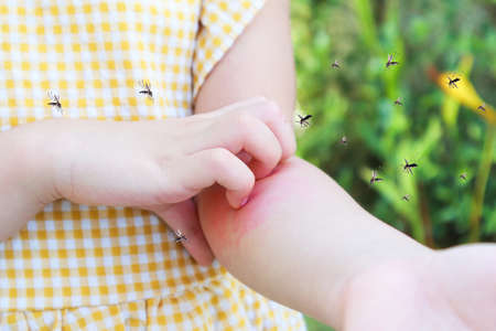 Little girl has skin rash allergy and itchy on her arm from mosquito biteの写真素材