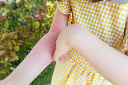 Little girl has skin rash allergy and itchy on her armの写真素材
