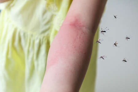 Little girl has skin rash allergy and itchy on her arm from mosquito bite