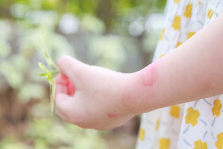 Little girl has skin rash allergy itching and scratching on her arm