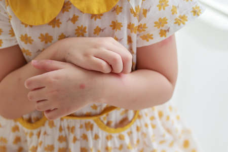 Little girl has skin rash allergy itching and scratching on her armの写真素材