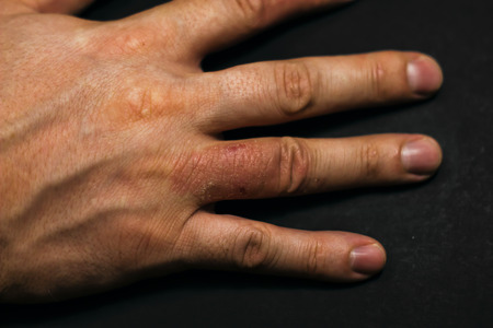 Hand dermatitis. Hand eczema closed on black backgroundの写真素材