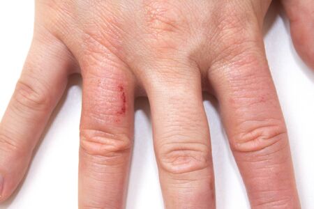 Hand dermatitis. Hand eczema closed on white background. Dermatitis is an inflammation of the skin