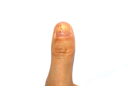 Close-up of a womans right thumb, with a torn or peeling nail. A broken or detached toenail. A...