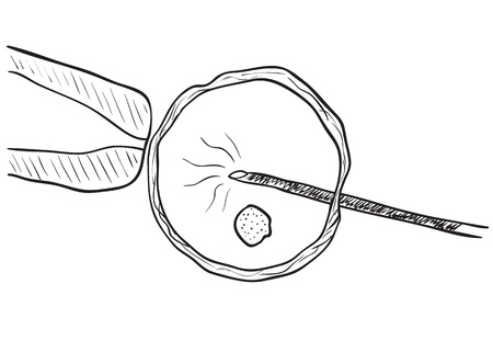 Illustration of artificial insemination of egg in vitroのイラスト素材