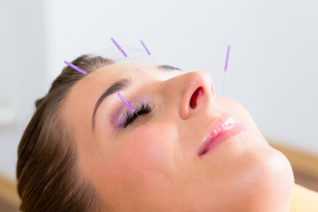 Woman at acupuncture with needles in face receiving alternative treatmentの写真素材