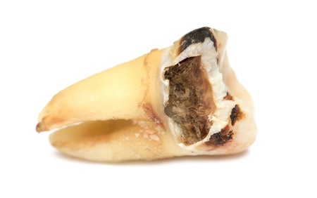 tooth with dental caries の写真素材