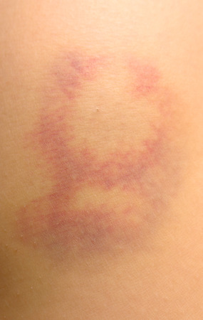 a large bruise on human skin