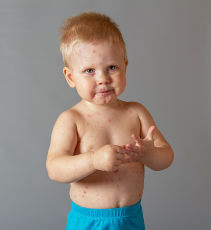 The little boy with the allergy symptoms skin rash of the body and faceの写真素材