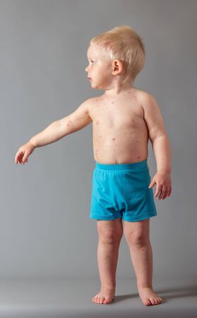 On the body of small boy rash from chickenpox, on gray backgroundの写真素材