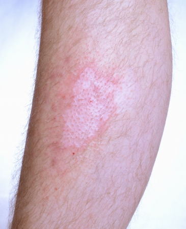 Irritated skin desease vitiligo on the leg.の写真素材