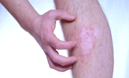 Itchy skin desease vitiligo and psoriasis. Hand scratching.の写真素材