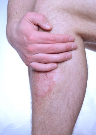 Hand covering itchy psoriasis. Conceptual image.の写真素材