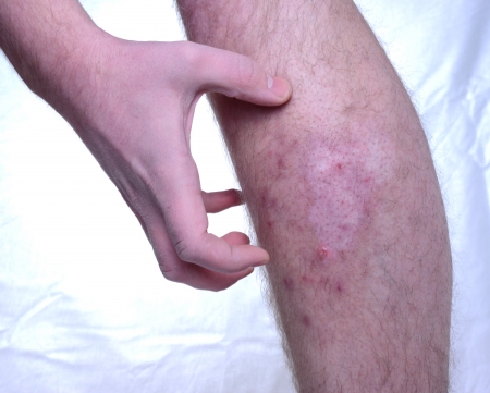 Itchy skin disease. Pigment missing in the skin.