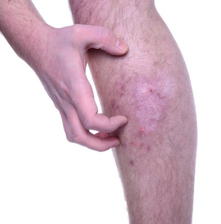 Hand scratching itchy infected skin.の写真素材