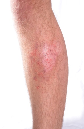 Infected skin. Mixture of psoriasis, vitiligo and acne.の写真素材