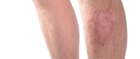 Panoramic image of skin infection on a leg. Isolated on white.の写真素材