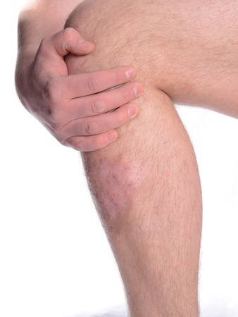 Conceptual image of being ashamed of skin disease.の写真素材