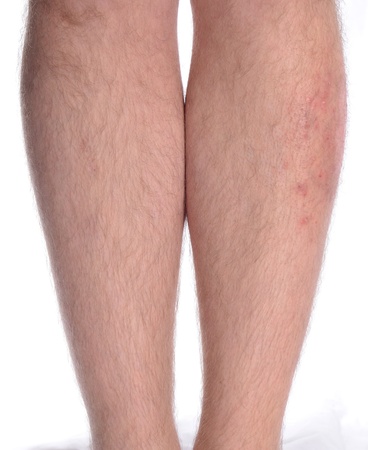 Patient suffering from psoriasis and vitiligo on the left leg.の写真素材