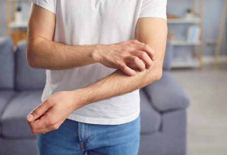 Man scratches his left hand due to itching from allergic skin reaction or due to insect bite....