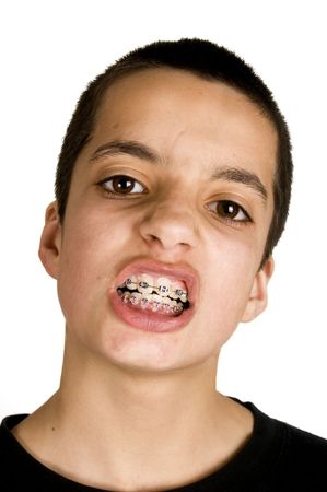 young handsome teenage is showing his dental braces